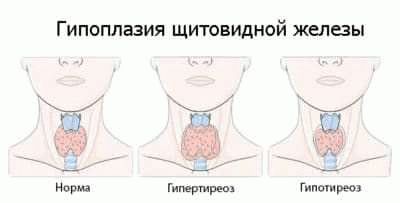 Влияние хронического тонзиллита на службу в армии