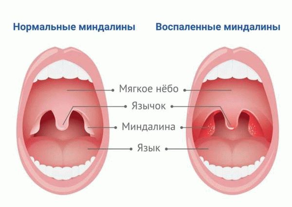 Хроническая форма тонзиллита и ее особенности