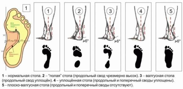 При какой степени точно не берут в армию?