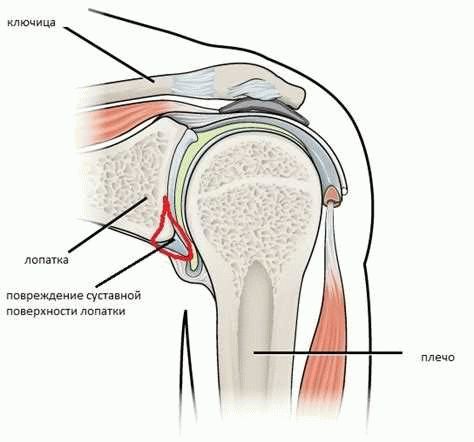 Причины возникновения вывиха плеча